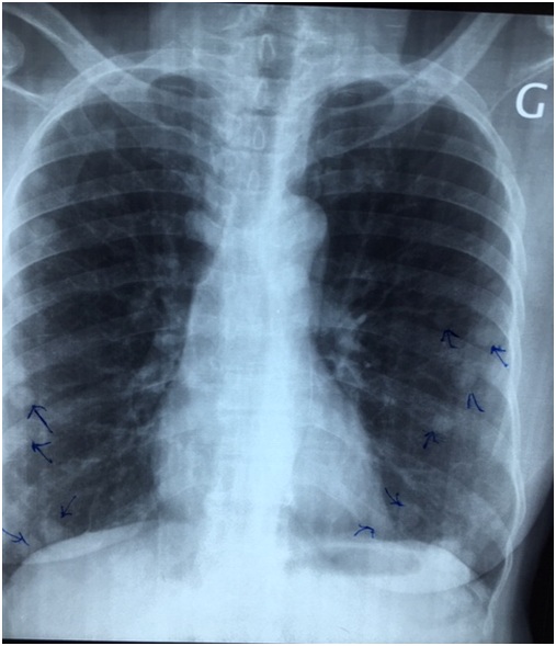 A Case of Endometrial Stromal Revealed by Lung Metastasis 7